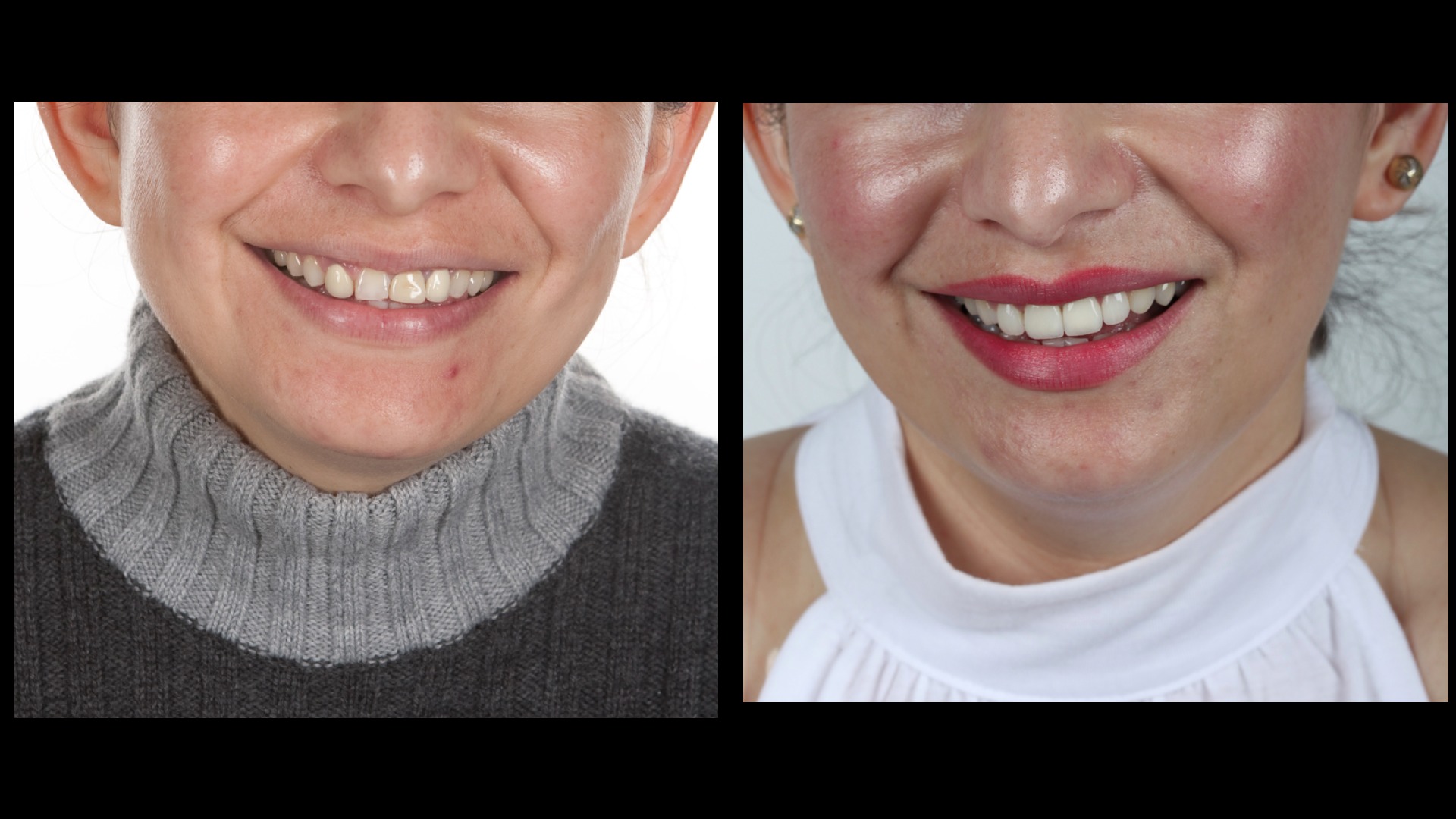 Dentist, Teeth Whitening, Cosmetic Dentistry, Restoration: Danbury, CT