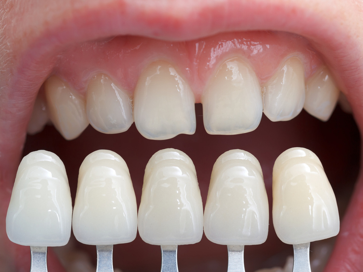 Porcelain Veneers: Danbury, CT: Main Street Advanced Dentistry